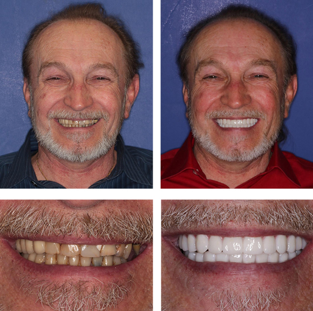 Before After Dental Impalnt 2